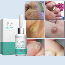Mole Skin Tag Repair Solution Painless Mole Skin Dark Spot Repair Face Wart Tag Freckle Repair CreHuid