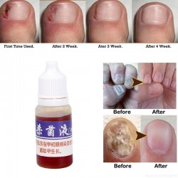 Chinese medicine - nail repair for onychomycosis - nail fungus - 10 mlTreatment