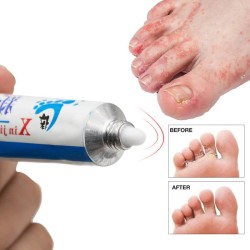Antibacterial feet ointment - anti itching - corn removal - anti-sweat - anti-odor - psoriasis