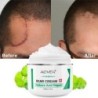 Littekenverwijderingscrème - striae - acne - gezichts- / lichaamsbehandeling - 50 mlHuid