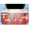 Laser epilator - permanent hair removal - IPL - 900000 - 5-gearHair removal