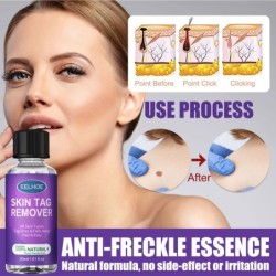 Skin tag / warts remover - dark spots / freckles - liquid - 30 mlSkin