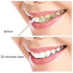 Teeth Whitening serum - gel - oral hygiene - toothpasteTeeth Whitening