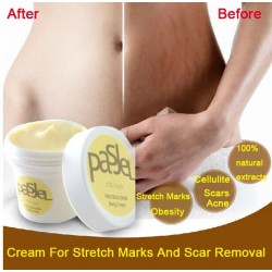 Stretch marks & scars removal cream