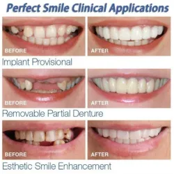 Silicone teeth cover - denture 2 piecesMouth